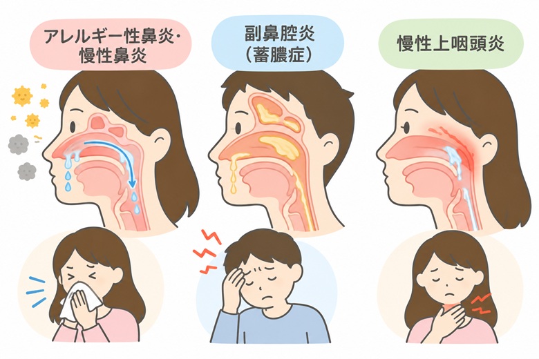 西洋医学でよく挙げられる後鼻漏の原因