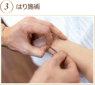 はり施術