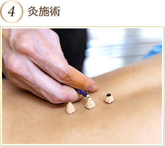 灸施術
